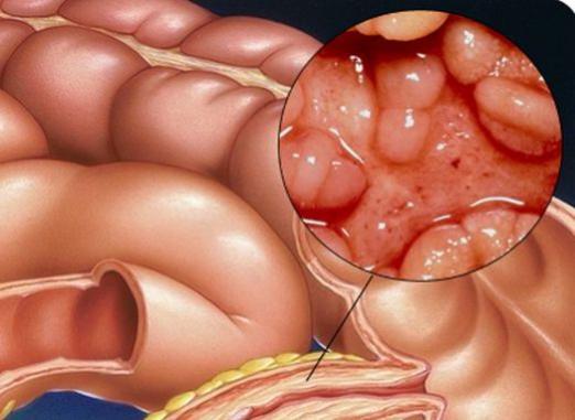 Η νόσος του Crohn: τι είναι αυτό;